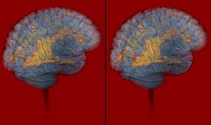 A sclerosis multiplex kezelését minél előbb meg kell kezdeni